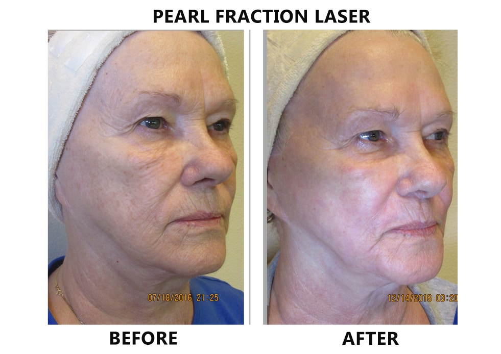 Pearl Fractional New Image Advanced Laser Skin Center Las Vegas